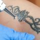 tattoo-removal - ازالة التاتو
